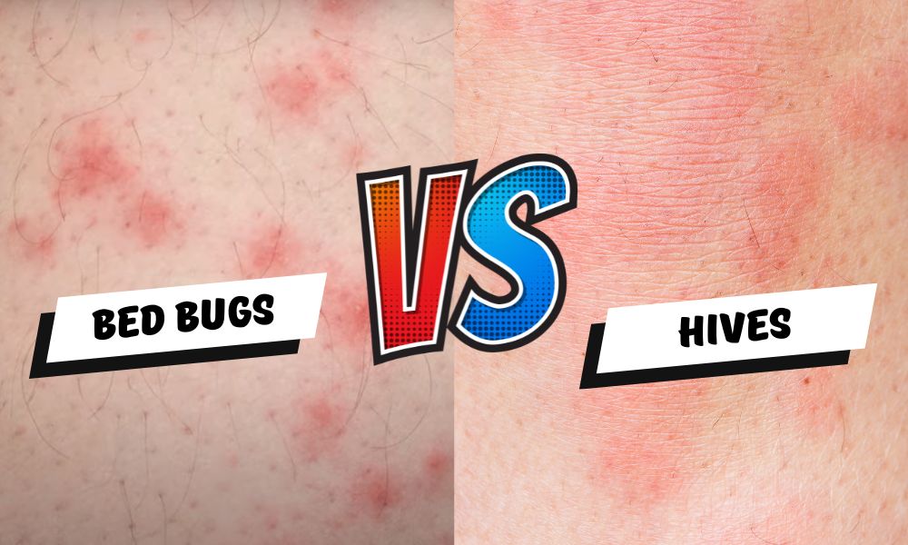 bed bugs vs hives